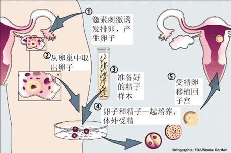 极光生殖